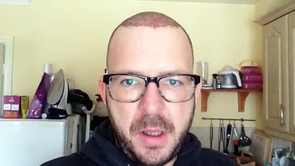 David  Patterson - Patient Journey Hair Transplant - Few Days After Surgery