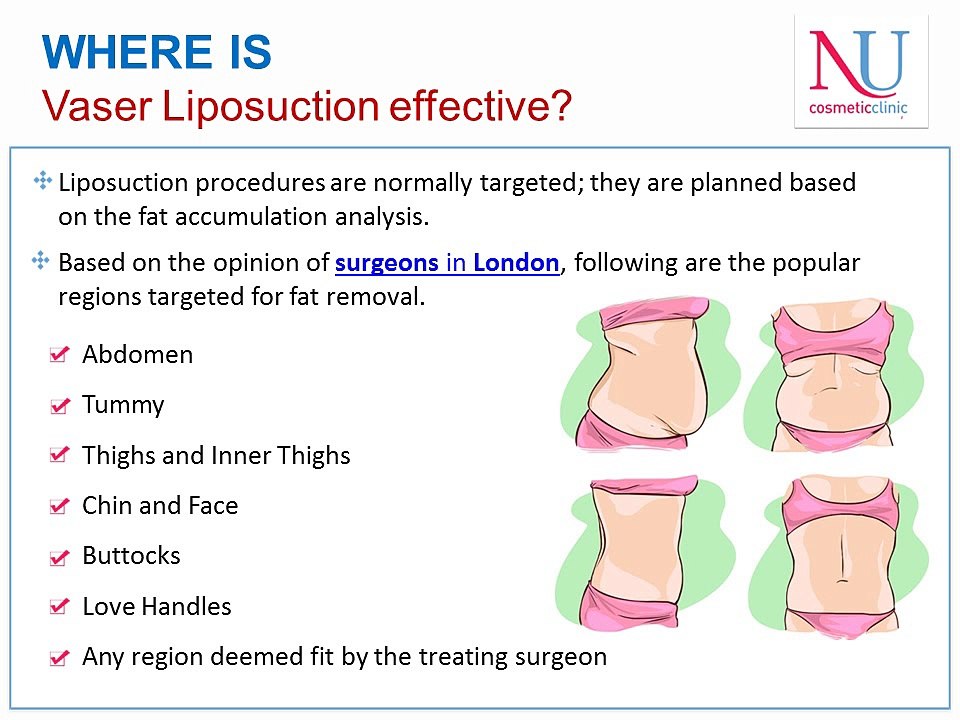 VASER Liposuction - Advanced Body Contouring Procedure for Men and Women -