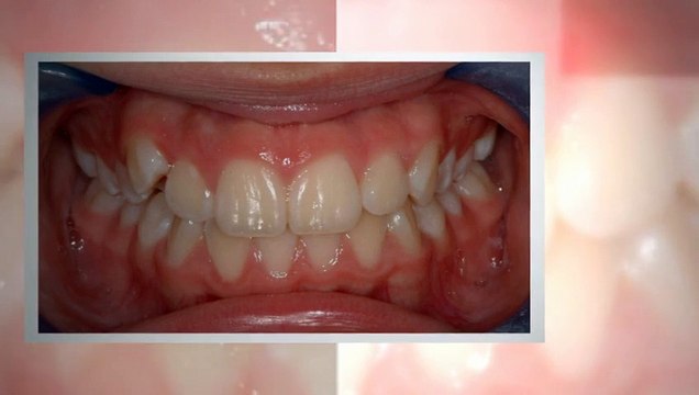 Littleton Braces - Duryea Orthodontics - (303) 933-0300