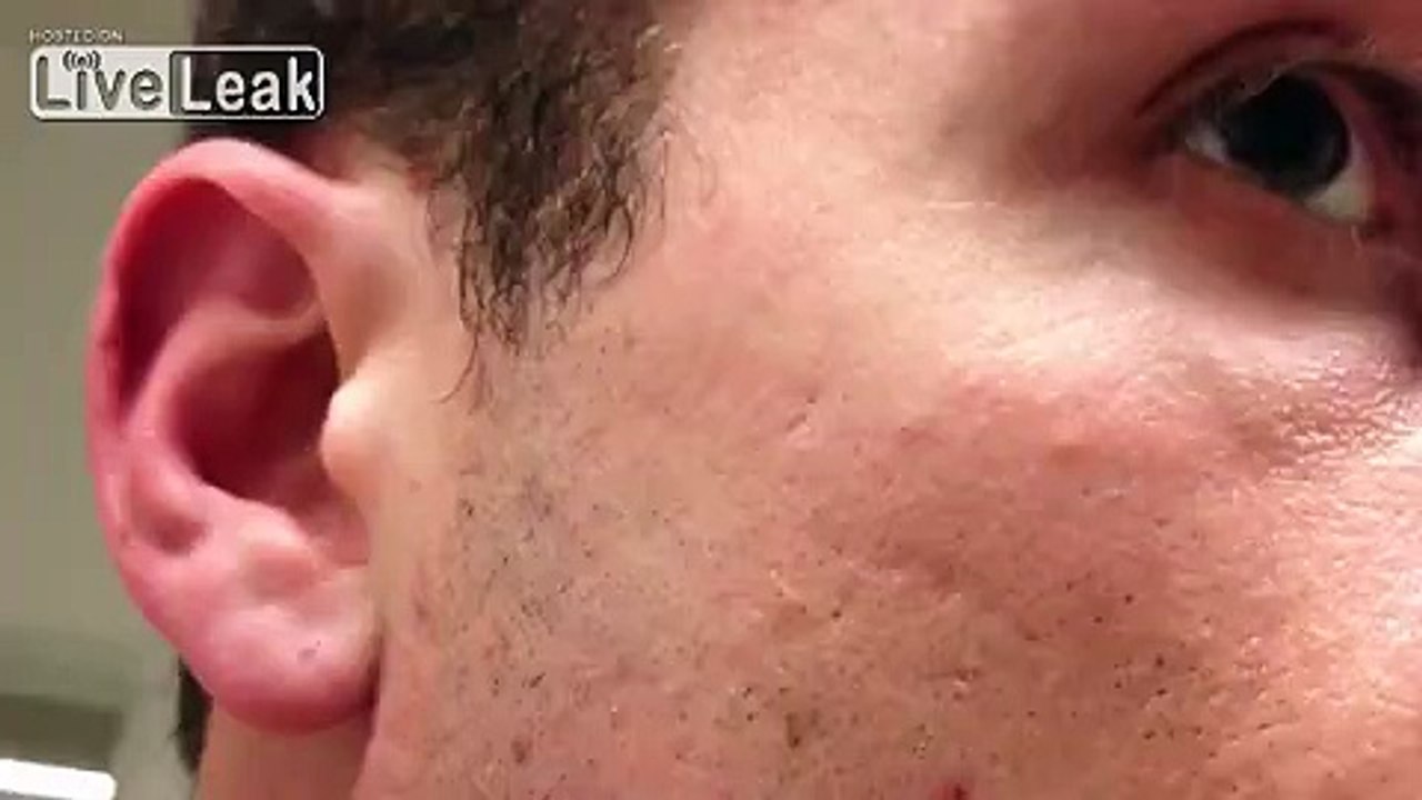 The World's Longest, Grossest Ingrowning Hair