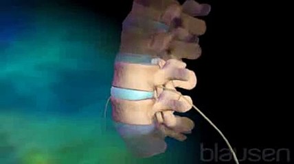 La chirurgie lombaire