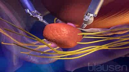 L'ablation de la prostate - Prostatectomie