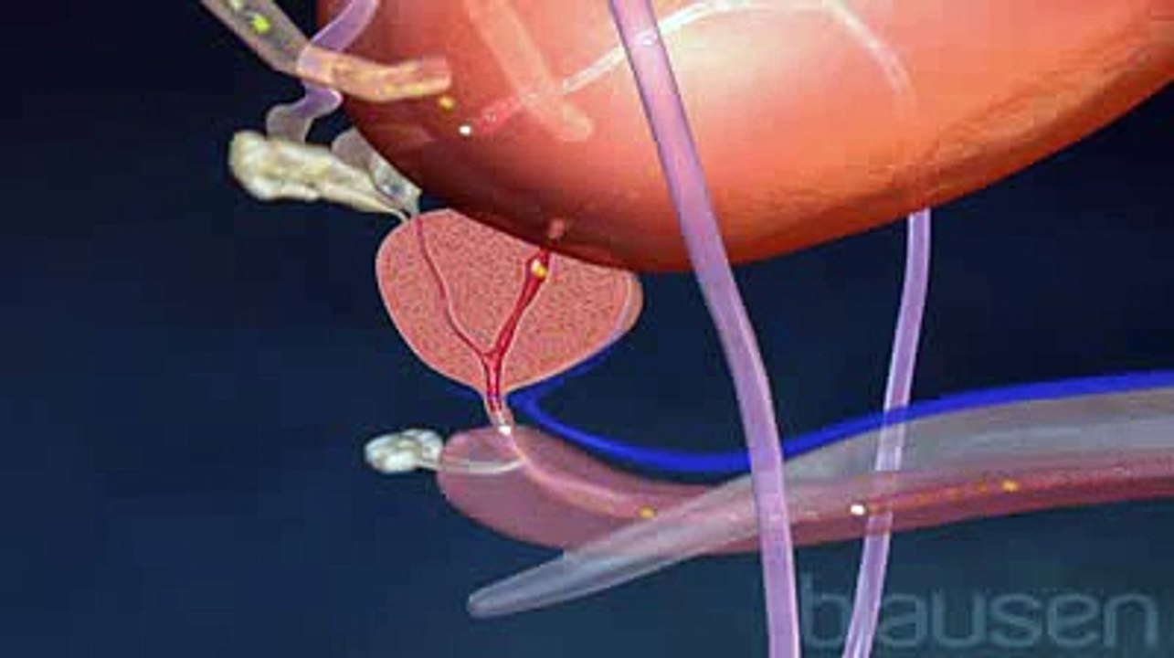 Le cancer de la prostate