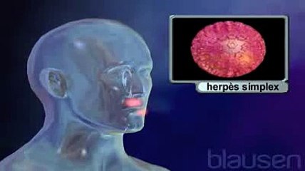 L'herpès - Bouton de fièvre - Herpès génital