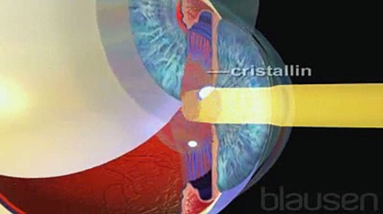 DMLA - Dégénérescence maculaire liée à l'âge