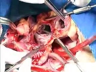 Un chirurgien filme une transplantation du coeur en direct