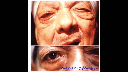 اصلاح و تجميل و شد  ارتخاء الجفن الأسفل و توضيح أضراره  د. هيام عادل   4