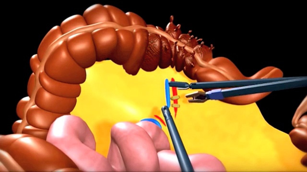 Diverticulose du colon sigmoïde : animation 3D - traitement - Vidéo ...