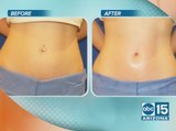 EnteBella can give you the face and body you deserve without the risks and downtime of surgery