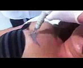 Harmony Elektra RemoÃ§Ã£o Tatuagem Dr Rafael e DR LASER