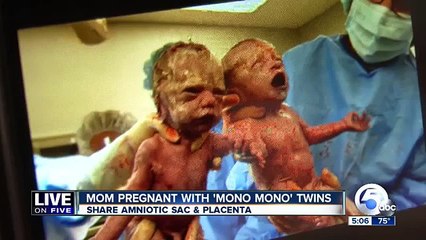 Des jumelles se tiennent la main à la naissance