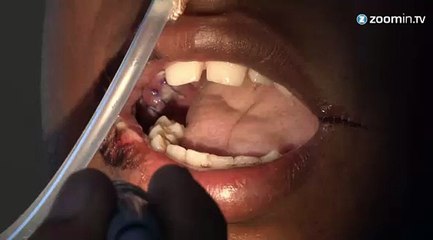 Inde: on lui retire 232 dents !