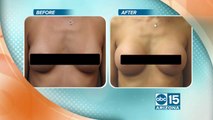 Dr. Kotoske explains breast augmentation at Cosmetic Surgery Institute