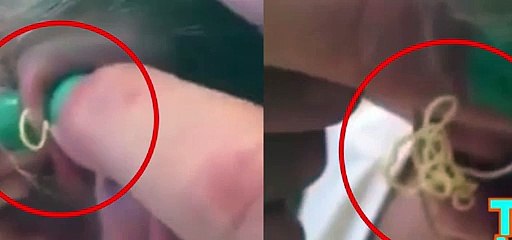 This girl squeezes a 6-year-old ear zit and a helluva a lot of pus comes out [Full Episode]