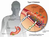 Diabetes  Factores en la Dieta para Diabeticos
