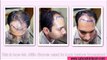 Hair Transplant at Affordable Cost in New Delhi | Hair Expert In India
