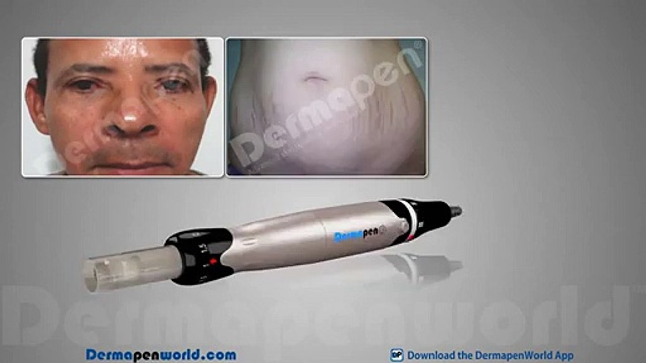 Dermapen 3 _ The Latest Micro Needling Device