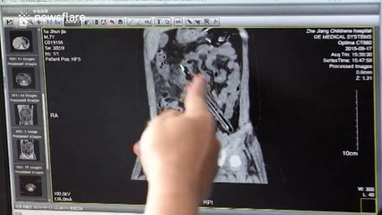 Eight-year-old boy has pencil stuck inside him for a month