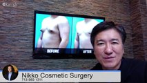Male Breast Reduction Houston- Dr. Nikko Answers Gynecomastia Questions