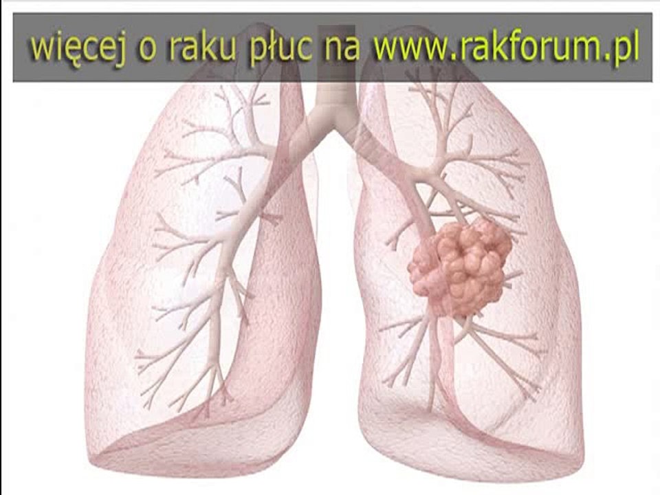 Dieu tri ung thu dai truc trang