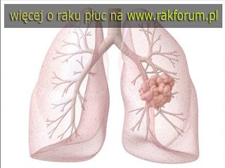 Dieu tri ung thu dai truc trang