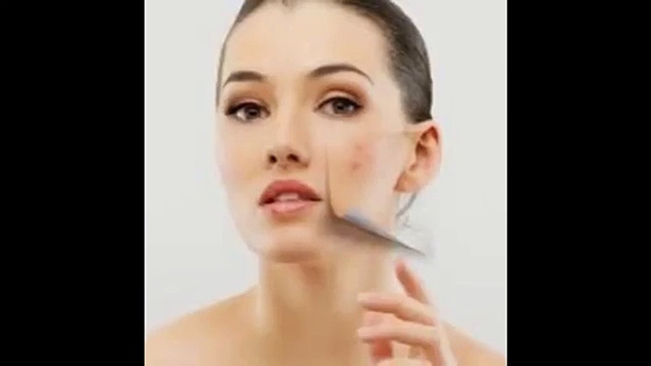 Permanent Treatment of Acne - Solutions for Pimples and Acne - Pimple.sg