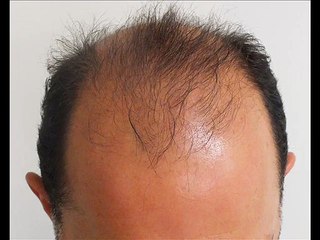 Dr. Ekrem Civas Hair Transplant Forum Result, hair transplant forum