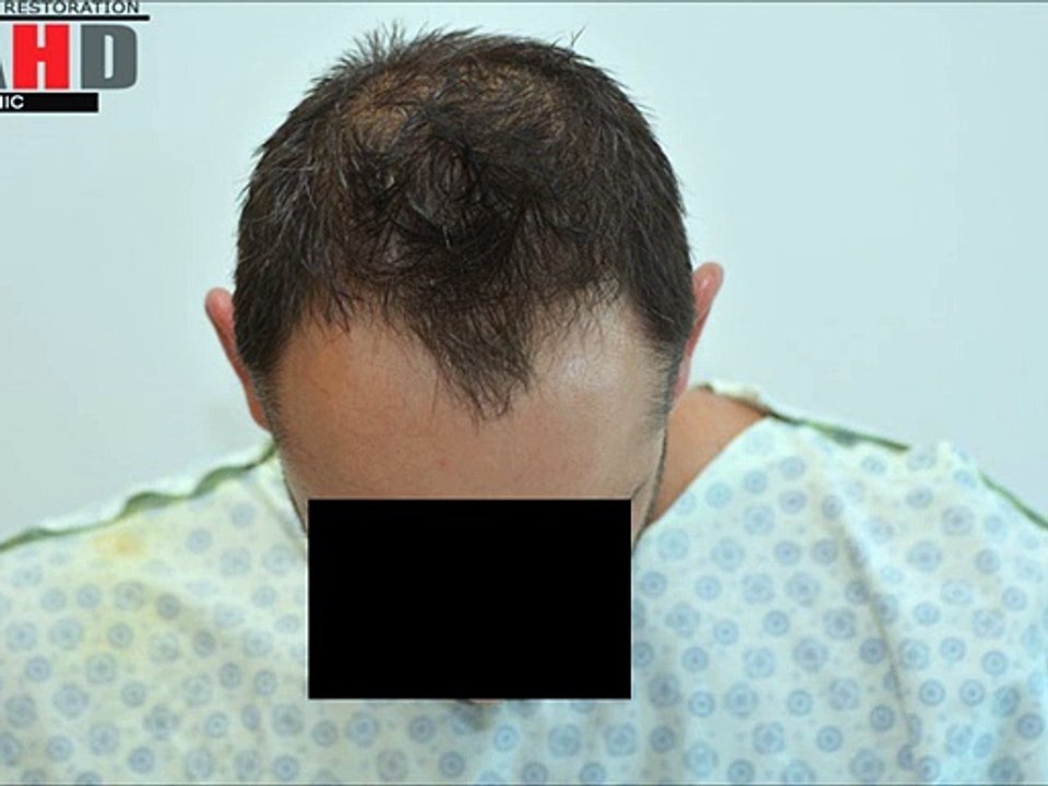 Dr Hakan Doganay Review 3000 grafts, FUE hair transplant forum, hair transplant turkey