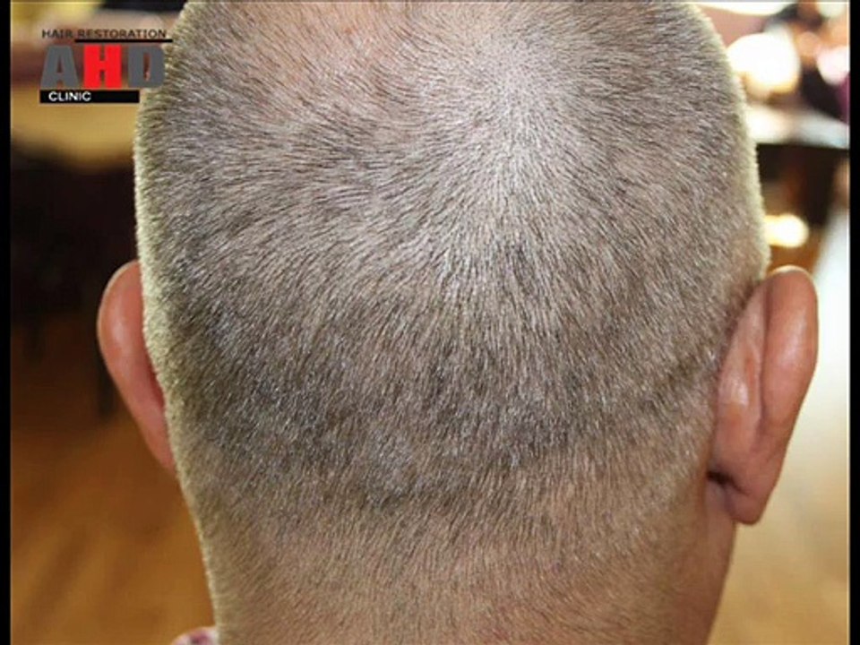 Dr Hakan Doganay Result, hair transplant forum, hair transplant turkey, hair transplant surgery FUE