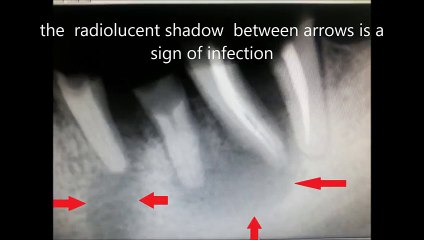 infection on dental x-ray and tooth