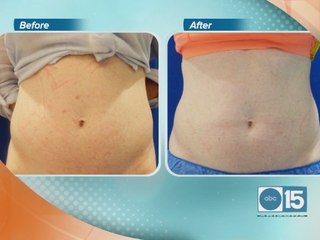 Getting your dream body without surgery at EnteBella