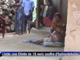 Inde: une petite fille au crâne hypertrophié suscite un élan de solidarité