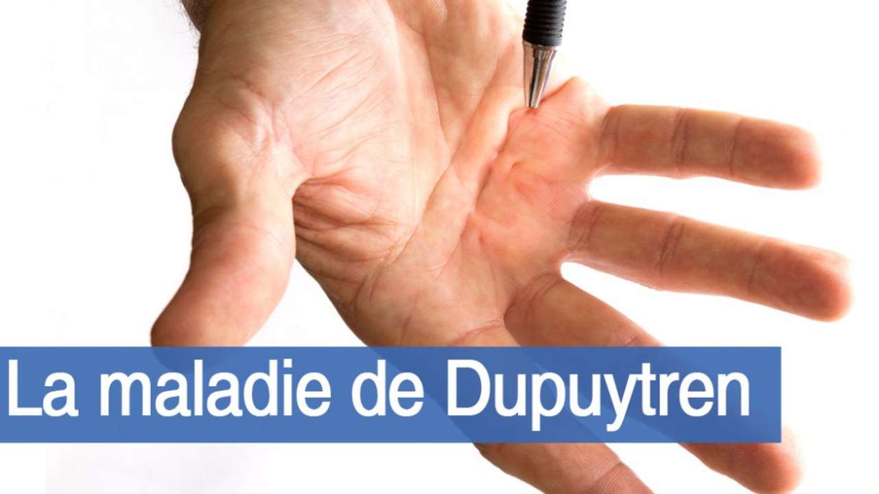 Dupuytren : peut-on prévoir l’évolution de cette maladie ?