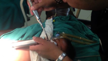 Removal of Anesthesia Machine