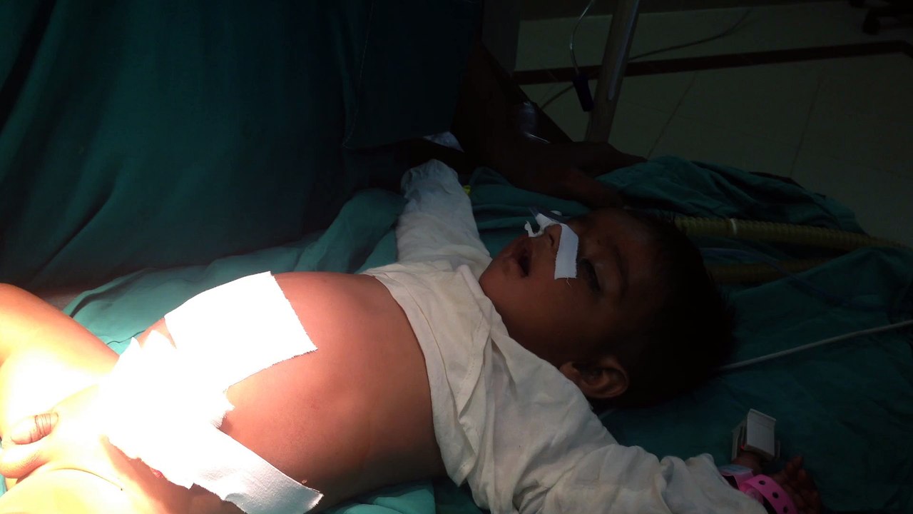After Removal of Anesthesia Machine (Normal Breathing)