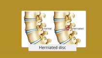 Minimally Invasive Spine Surgery