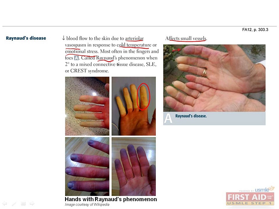 Cardiovascular Pathology Part 4