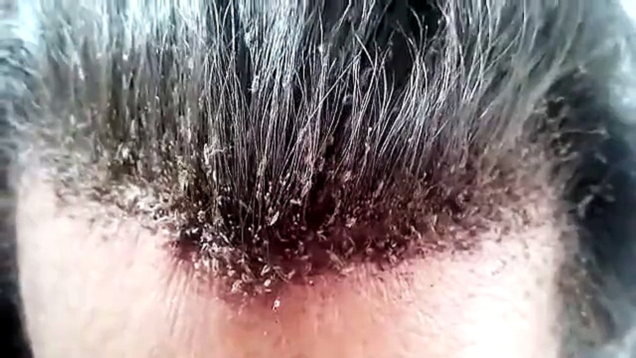 Women's head covered in lice