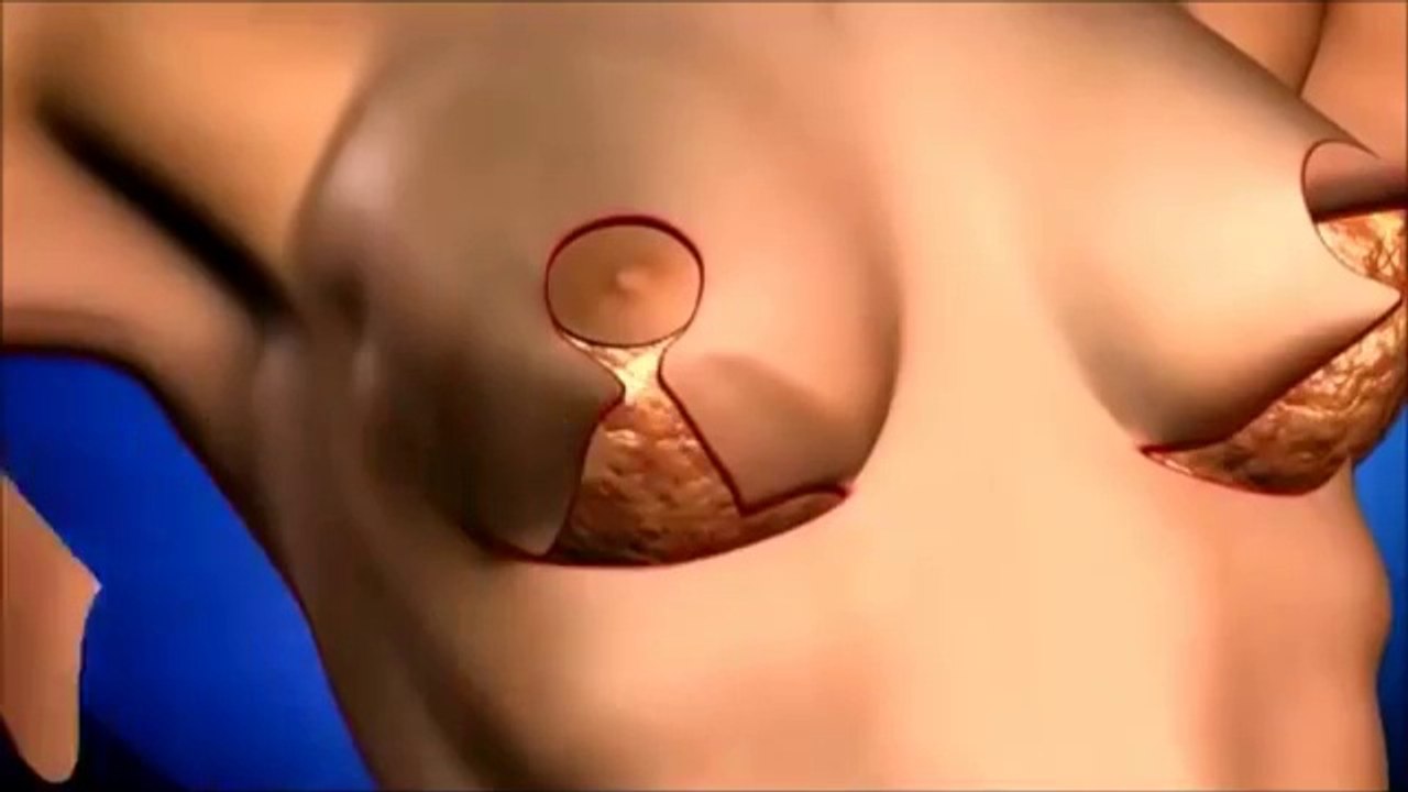 Lifting seins Tunisie  : chirurgie ptose mammaire