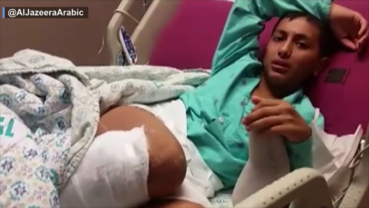 بتر ساق طفل فلسطيني أصابه الاحتلال