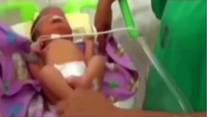 This baby was born with two noses as a result of an ultra-rare genetic condition