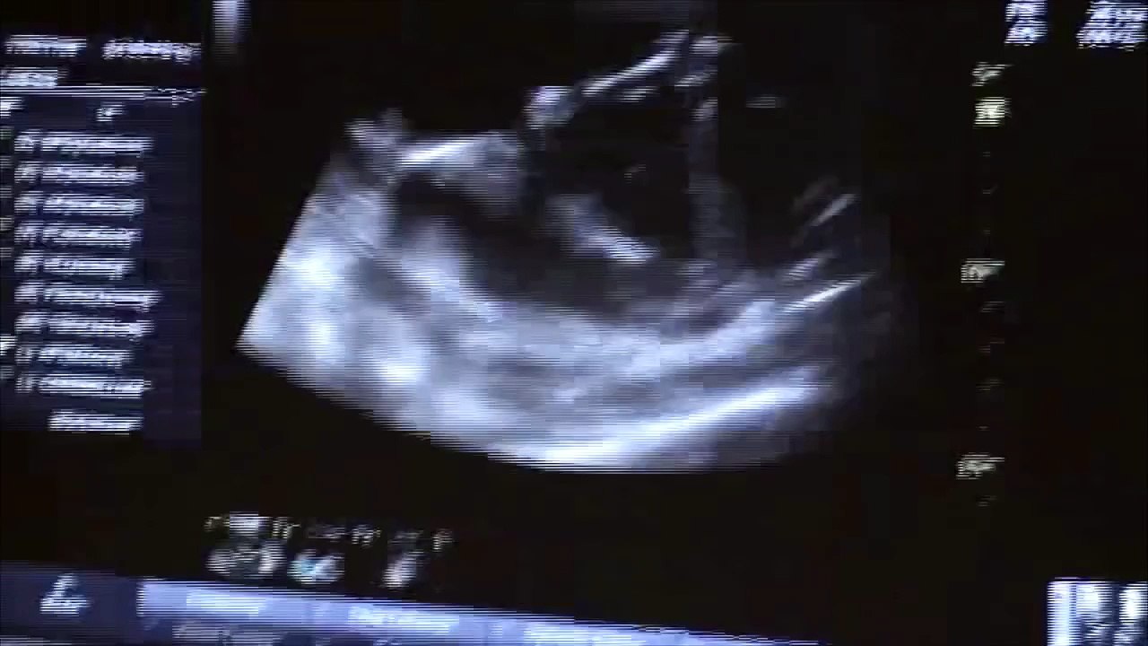 Baby gives thumbs-up in ultrasound