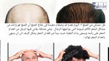 أسباب وعلاج الصلع و طريقة لعودة الشعر من جديد
