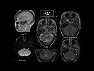 Une masse calcifiée