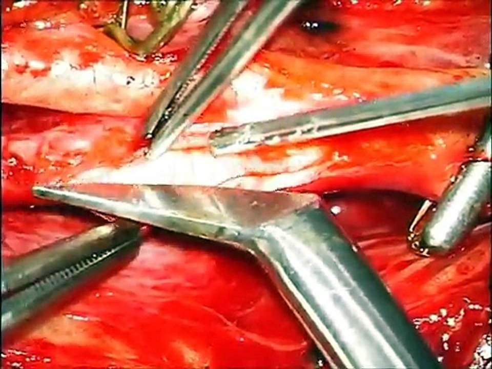 Carotid Endarterectomy