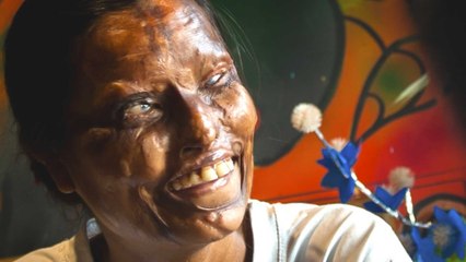 Acid Attack Café Restores Victims' Lives