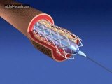 ANGIOPLASTY STENT