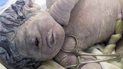 Baby Born With ONE Eye And NO Nose! | Shocking