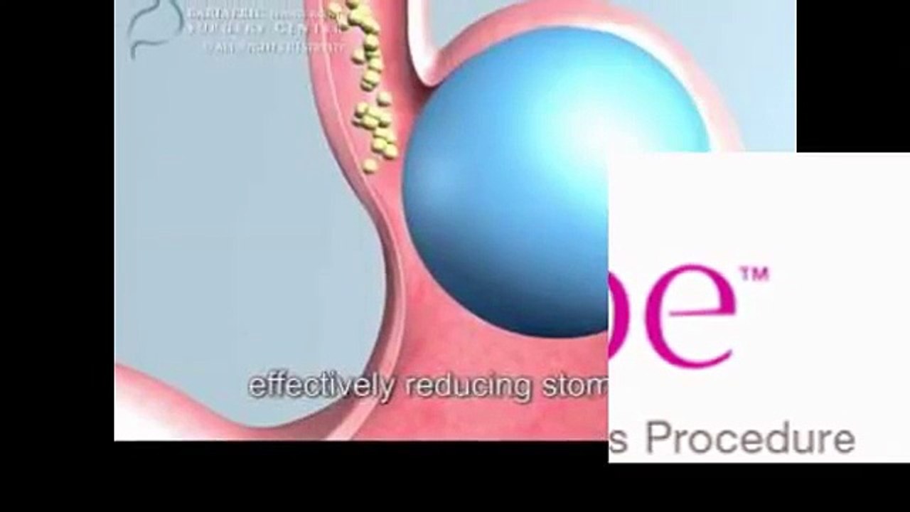 weight loss balloon