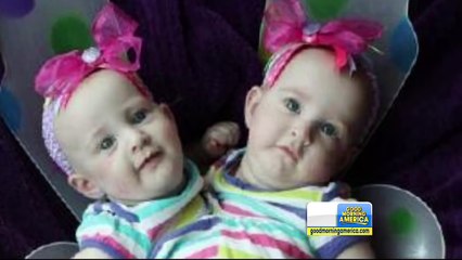 Separation de Jumelles Siamoises